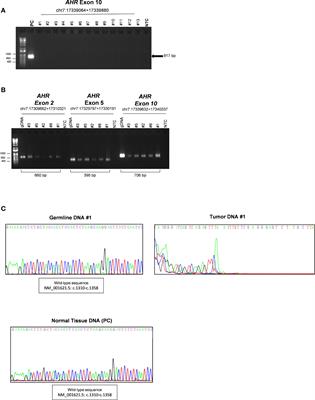 Somatic Deletion in Exon 10 of Aryl Hydrocarbon Receptor Gene in Human GH-Secreting Pituitary Tumors